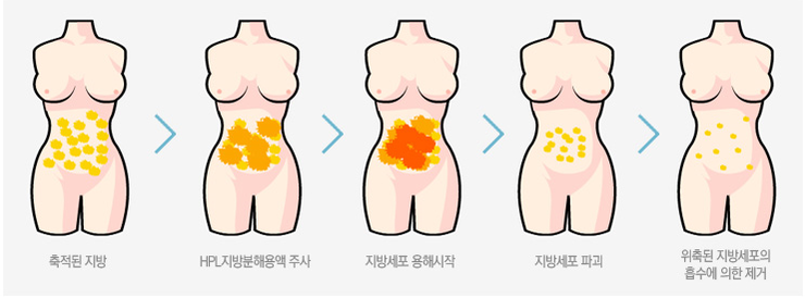 [목동HPL] 군살 없는 배 복부 지방분해주사 복부HPL 관련 이미지 2