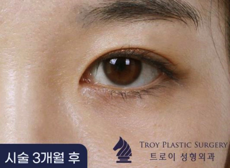 목동역성형외과 잘 고르는 핵심 알려드립니다 관련 이미지 2
