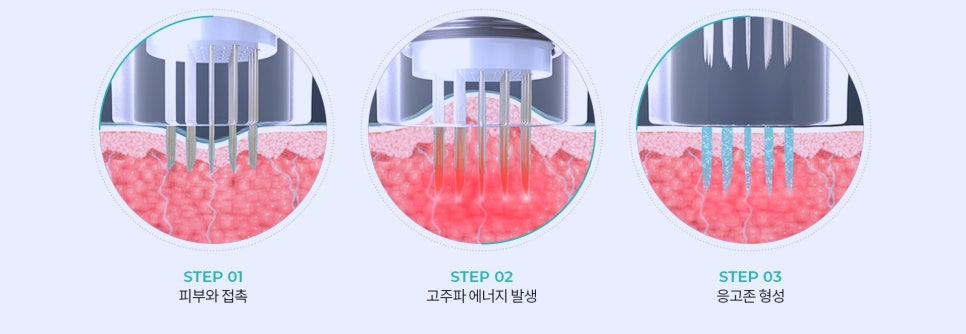 목동포텐자 레이저 잘하는 곳에서 모공고민 해결! 관련 이미지 5