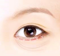 목동눈성형 처진 눈 수술 이것 3가지로 종결(상안검/눈썹하거상/하안검) 관련 이미지 5