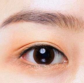 김포 쌍수 잘하는 곳에서 알려주는 돌출눈/함몰눈 추천 수술법 및 라인 관련 이미지 2