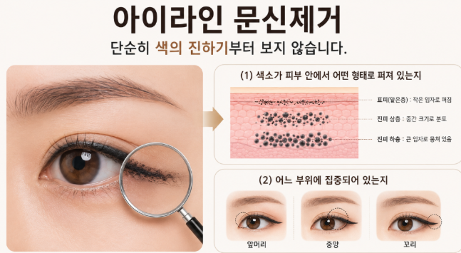 Mok-dong Eyeliner Tattoo Removal: What Matters More Than Color Is the Way It Has Spread image 1