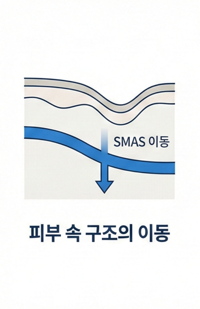 목동 안면거상, 리프팅으로 더 이상 버티기 어려운 신호들 관련 이미지 7