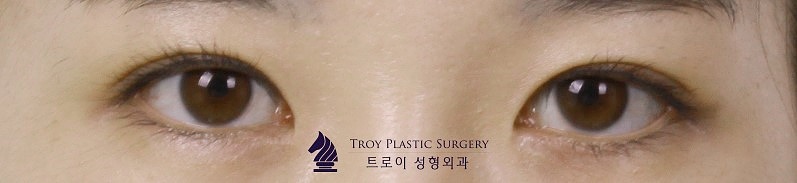 김포눈성형 나에게 어울리는 쌍꺼풀 라인 찾는 법(인라인vs아웃라인) 관련 이미지 1