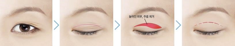 목동상안검 처진눈매를 또렷하고 시원하게 관련 이미지 1