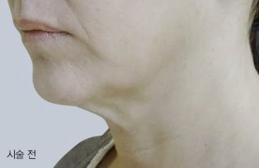 목동역피부과 인모드 잘하는 곳? 관련 이미지 5