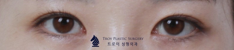 목동쌍꺼풀 돌출눈/함몰눈 추천 수술방법 및 라인 관련 이미지 4
