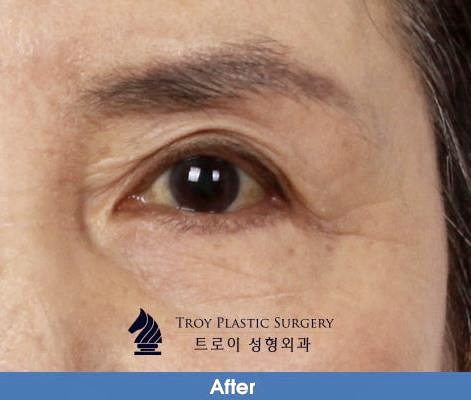 목동성형외과 중년눈성형 잘하는 곳에서 추천하는 수술 4가지 관련 이미지 2