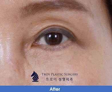 목동중년쌍수 부작용 걱정되시는 분들은 보세요 관련 이미지 3