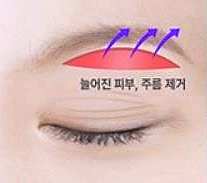 김포눈썹거상 목동까지 찾아오는 이유 관련 이미지 1