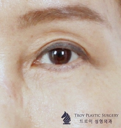 Mok-dong Eye Surgery: 3 Recommended Surgeries for Sagging Eyes (Upper Blepharoplasty / Brow Lift / Lower Blepharoplasty) image 2