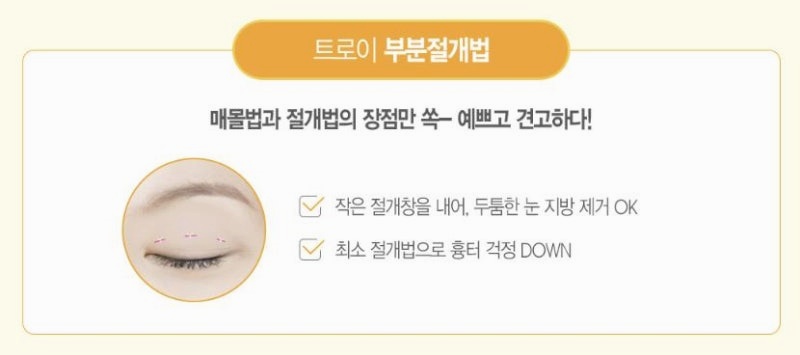목동 쌍꺼풀수술 붓기, 매몰vs절개 어떤게 더 빨리 빠지나요? 관련 이미지 4