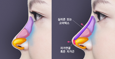 [양천구성형외과] 자신감까지 높이는 낮은코성형 방법 알아보기 관련 이미지 3