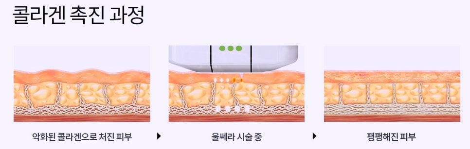 목동울쎄라 리프팅, 300샷? 600샷? 추천 샷수는? 관련 이미지 2