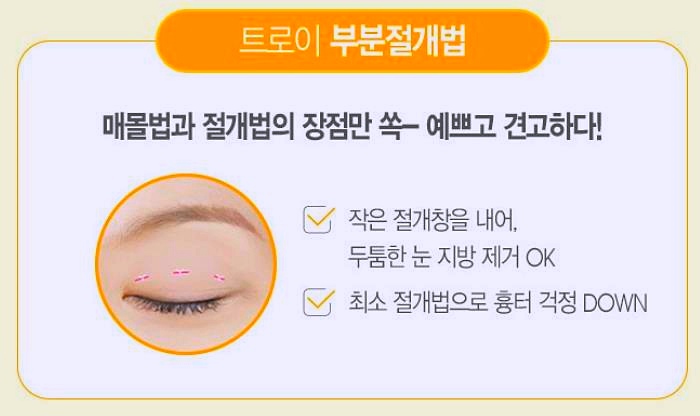 오목교쌍수 잘 하는 곳에서 알려주는 절개, 매몰 선택법 관련 이미지 4