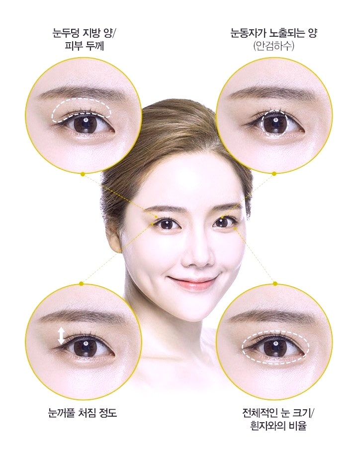 목동 쌍수 아웃라인? 인라인? 나에게 어울리는 라인 찾는 방법 관련 이미지 1