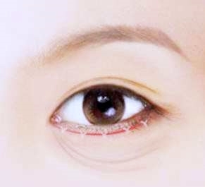 김포하안검 안검외반 부작용 무조건 생기는 건가요? 관련 이미지 1