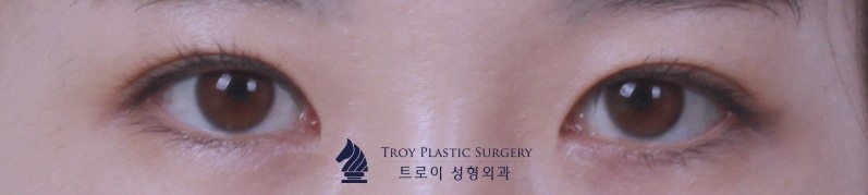 목동쌍꺼풀 수술 실패하지 않는 방법 관련 이미지 1