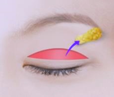 목동쌍꺼풀 수술 실패하지 않는 방법 관련 이미지 2