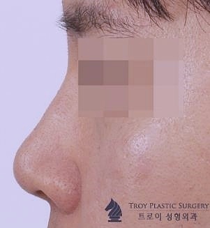 목동필러, 만족스러운 결과 원한다면 관련 이미지 3