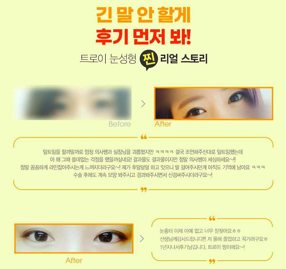 영등포쌍수 매몰vs절개 나에게 적합한 수술 방법은? 관련 이미지 4