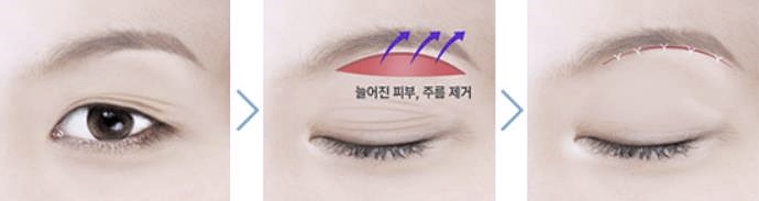 목동눈썹거상 수술 흉터 걱정을 덜 수 있는 곳 관련 이미지 1