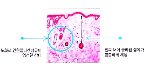 목동실리프팅 통증 걱정되신다면 ○○○○ 하는 곳으로 가세요 관련 이미지 2