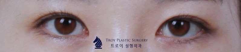 Mokdong Station Double Eyelid Surgery: Are the Surgical Methods Different for Protruding Eyes and Deep-Set Eyes? Don’t Regret Not Knowing image 5