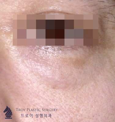 목동중년눈성형 유형별 추천 수술 3가지 관련 이미지 3