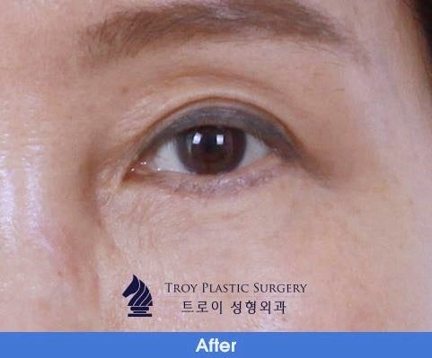 목동상안검, 처진 눈 관련 이미지 2