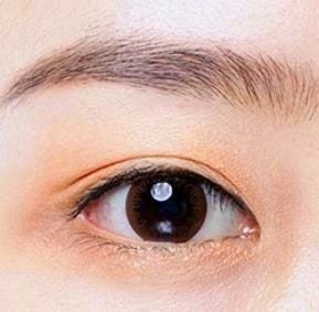Mokdong Station Double Eyelid Surgery: Are the Surgical Methods Different for Protruding Eyes and Deep-Set Eyes? Don’t Regret Not Knowing image 2