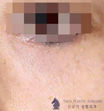 김포 눈밑지방재배치 흉터 남을까 봐 걱정이신 분들은 보세요 관련 이미지 3