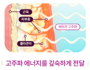 목동역 써마지 FLX, 탄력 리프팅에 효과 있을까? 관련 이미지 6