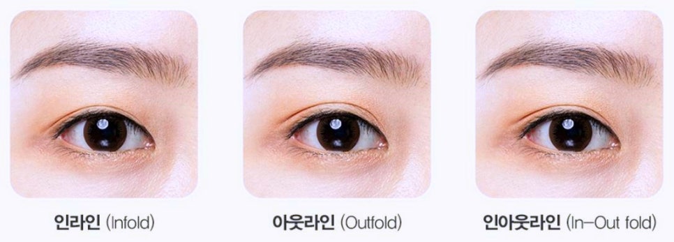 목동쌍수 매몰? 절개? 부분절개? 뭐가 더 좋나요 관련 이미지 4