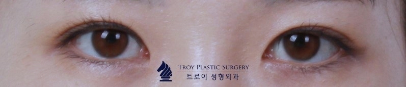 김포 쌍수 잘하는 곳에서 알려주는 돌출눈/함몰눈 추천 수술법 및 라인 관련 이미지 4