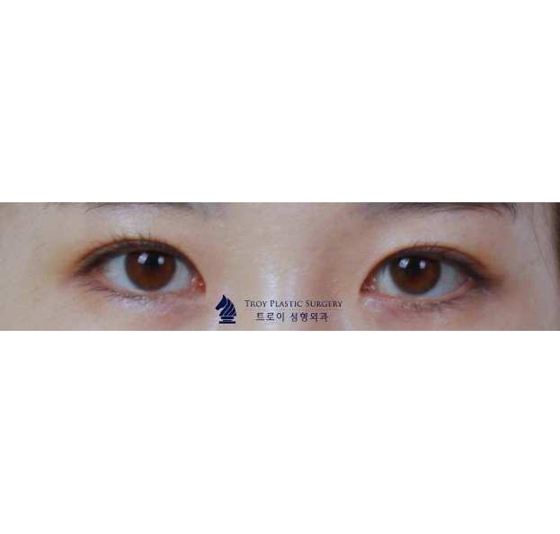 영등포쌍수 매몰vs절개 나에게 적합한 수술 방법은? 관련 이미지 3