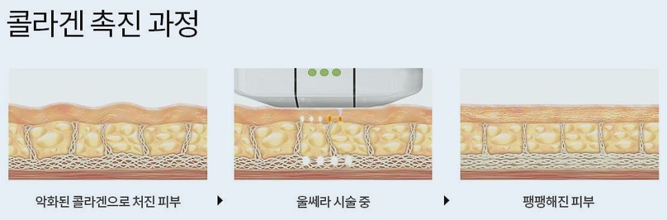 목동울쎄라 의사들이 말하는 성공 핵심 1가지 관련 이미지 1