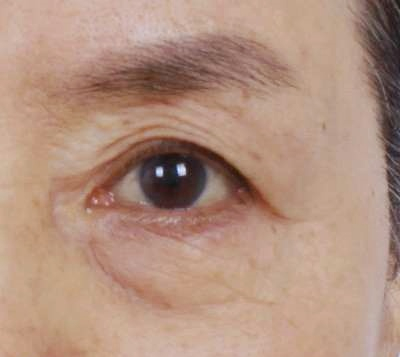 Recommended Types of Mokdong Middle-Aged Eye Surgery: 3 Surgery Options for Drooping Eyes image 2