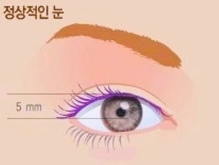 목동 눈매교정 남자 안검하수 가장 중요한 관련 이미지 2