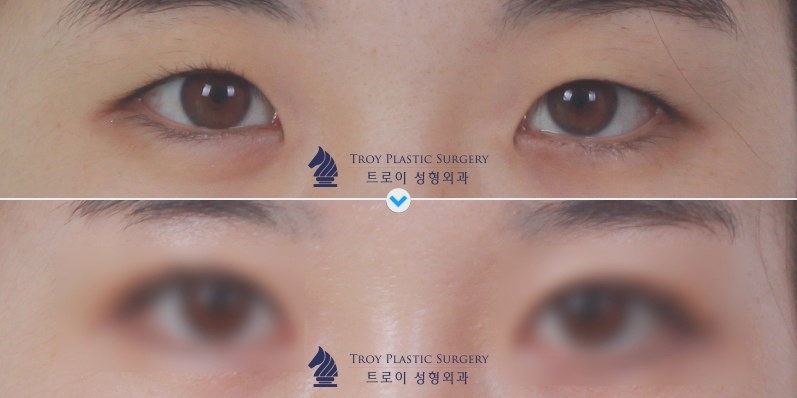 목동트임성형, 나는 앞트임? 뒤트임? 뭐가 필요할까 관련 이미지 4