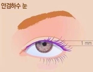 목동 눈매교정 남자 안검하수 가장 중요한 관련 이미지 3