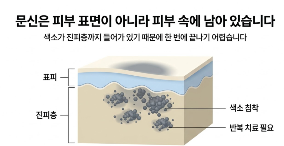 [Mokdong Station Tattoo Removal] The Real Reason You Should Start Before Clothes Get Thinner image 2