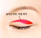 목동눈성형 처진 눈 수술 이것 3가지로 종결(상안검/눈썹하거상/하안검) 관련 이미지 1