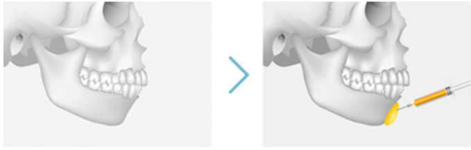 Mokdong Station Fillers: What’s the Most Effective Choice by Facial Area? image 6