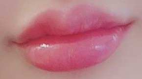 목동필러 부작용 걱정되시는 분들은 보세요 관련 이미지 1