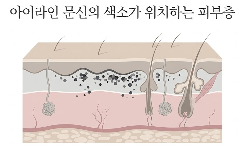 아이라인문신제거 후에도 색이 남아있다면? 색소깊이가 결정하는 이유 관련 이미지 2