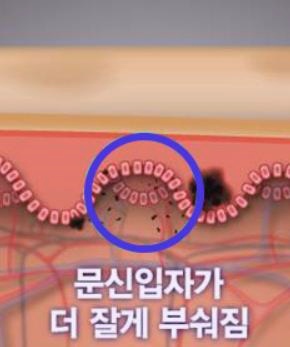 목동문신제거 레이저 통증은 줄이고 효과는 배로 높이는 방법 관련 이미지 3