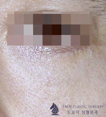 김포하안검 안검외반 부작용 무조건 생기는 건가요? 관련 이미지 4