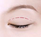 오목교역성형외과 중년쌍수 상안검 부작용 걱정? 이걸로 끝 관련 이미지 2