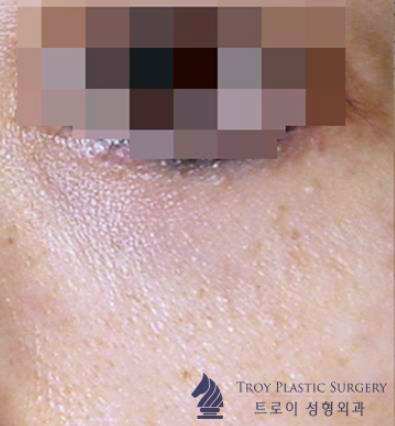 영등포성형외과 5060대 유형별 눈처짐수술 4가지 관련 이미지 4